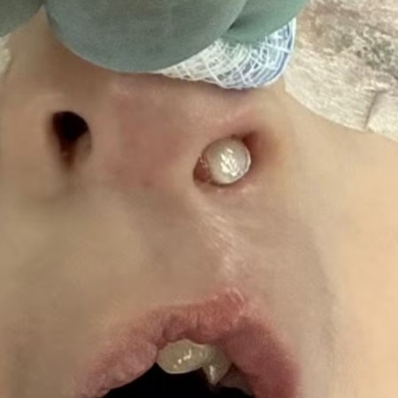 M�dica se surpreende ao descobrir dente nascendo no nariz de paciente de 3 anos