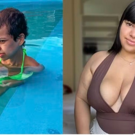Mulher vai da obesidade com 115 Kg  desnutrio severa com 32 Kg aps cirurgia baritrica