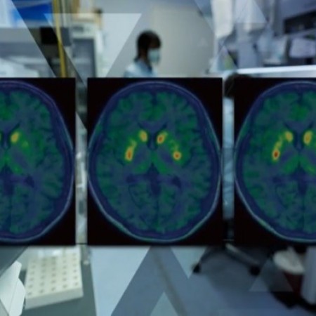 EUA aprovam rem�dio para Parkinson que age de jeito in�dito no c�rebro