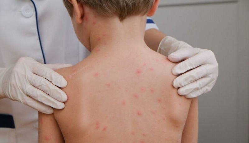 Para�ba � o 2� estado do Brasil com menos casos de meningite