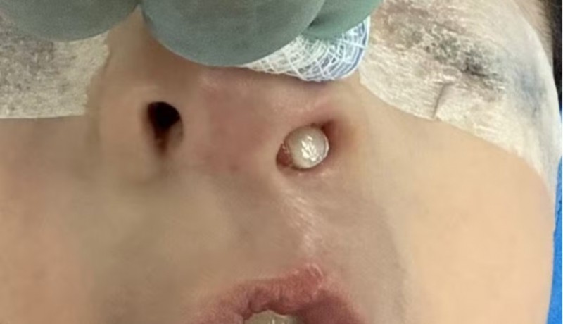 M�dica se surpreende ao descobrir dente nascendo no nariz de paciente de 3 anos