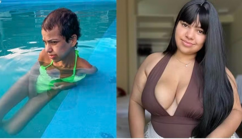 Mulher vai da obesidade com 115 Kg  desnutrio severa com 32 Kg aps cirurgia baritrica