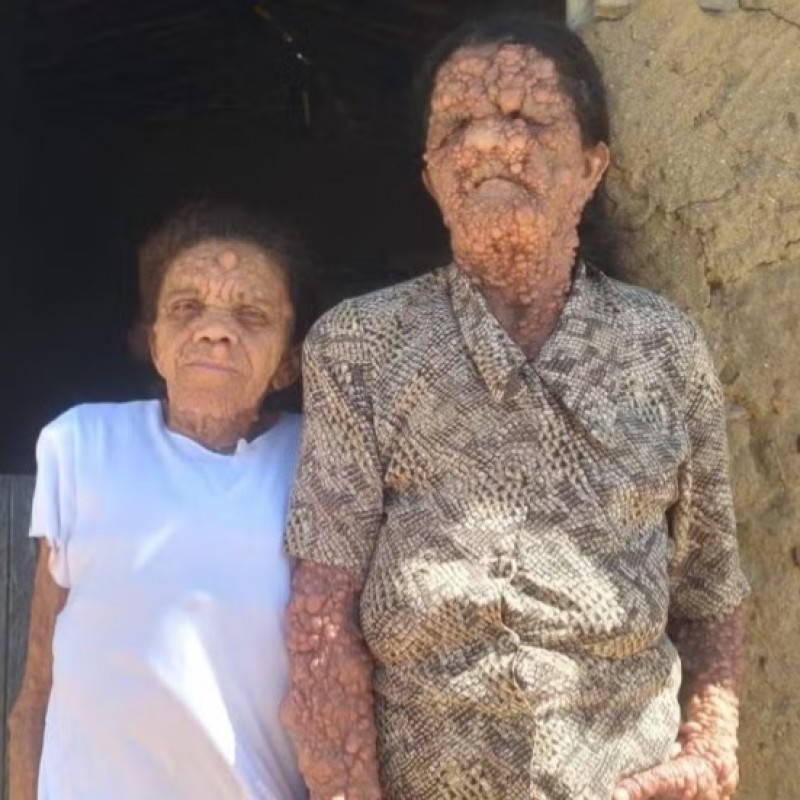 Neurofibromatose: m�e e filha na Para�ba convivem com doen�a rara que atravessa gera��es